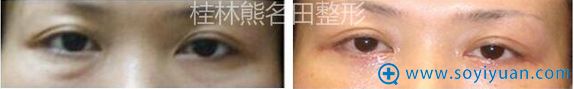 <!--<i data=20240710 data-id=13403></i>-->祛眼袋术后效果 <!--<i data=20240710 data-id=13403></i>-->祛眼袋术后效果