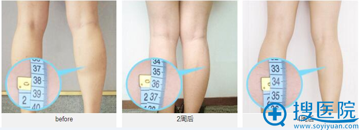瘦小腿对比图 瘦小腿对比图