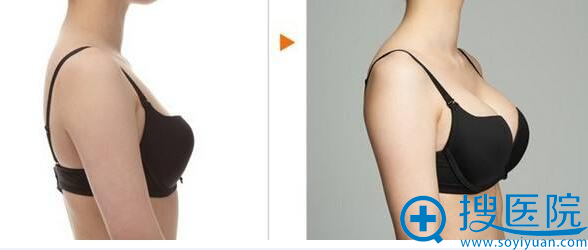 假体隆胸对比图 假体隆胸对比图