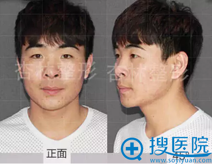 术前照片 术前照片