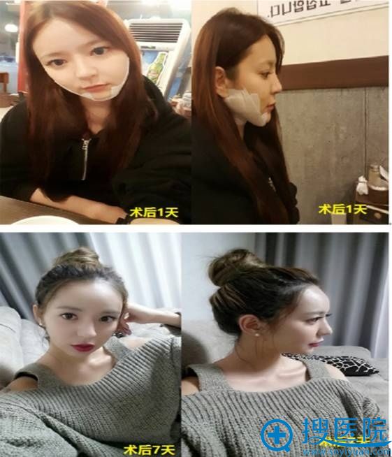 高级V轮廓术术后1-7天照片 高级V轮廓术术后1-7天照片