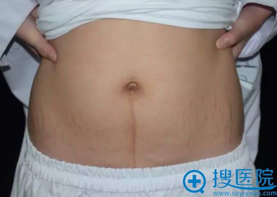 在广州华美整形医院做妊娠纹术前照 在广州华美整形医院做妊娠纹术前照