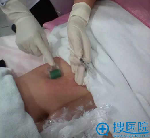 医生正在进行滚针 医生正在进行滚针