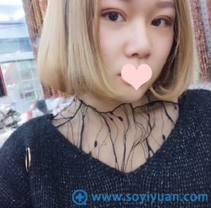 双眼皮7天拆完线的样子 双眼皮7天拆完线的样子
