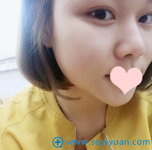 双眼皮术后20天,恢复的很好 双眼皮术后20天,恢复的很好