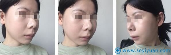 下颌角颧骨下巴手术1个月 下颌角颧骨下巴手术1个月