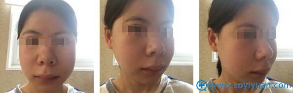 面部轮廓手术14天后口腔拆线。 面部轮廓手术14天后口腔拆线。