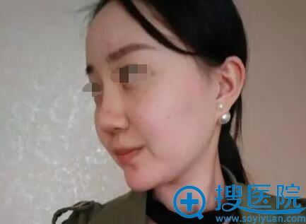 深圳联合丽格整形美容医院王宗学鼻综合修复手术全过程