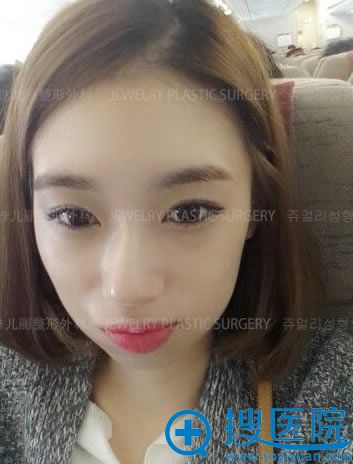 在韩国珠儿丽整形外科做眼鼻修复术前照 在韩国珠儿丽整形外科做眼鼻修复术前照