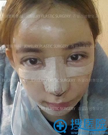 在韩国珠儿丽做鼻部修复术后第2天 在韩国珠儿丽做鼻部修复术后第2天
