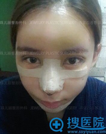 双眼皮修复术后第5天恢复效果 双眼皮修复术后第5天恢复效果