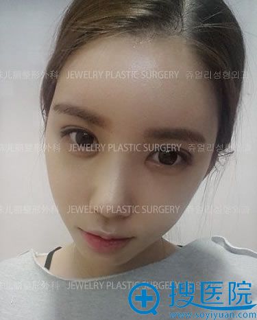 下巴假体填充术后21天恢复照 下巴假体填充术后21天恢复照