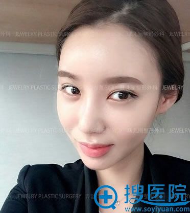 韩国珠儿丽整形术后30天效果图 韩国珠儿丽整形术后30天效果图