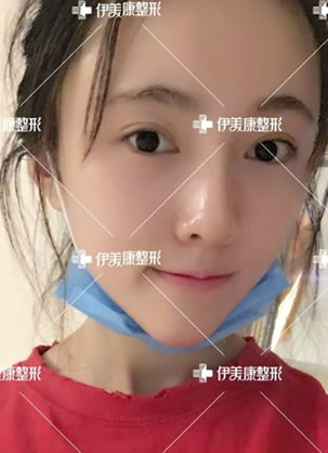 北京伊美康整形医院黄元生主任自体脂肪填充面部案例大集合