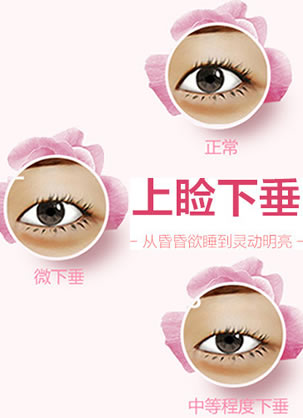 上睑松弛整形术价格是多少钱?青岛铭医整形刘世明院长5800元
