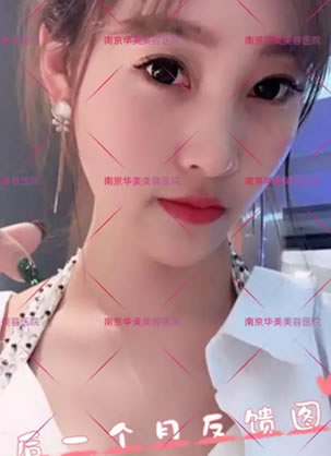 南京华美整形沈正宇自体脂肪面部填充和案例 秒变小V脸