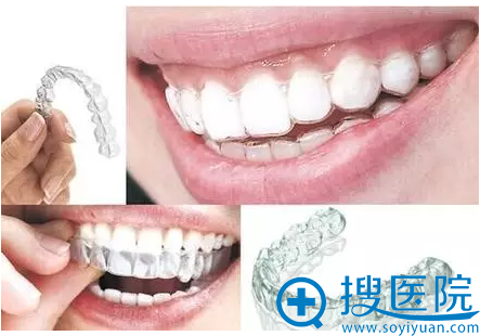 Invisalign隐适美G7牙套矫正效果 Invisalign隐适美G7牙套矫正效果