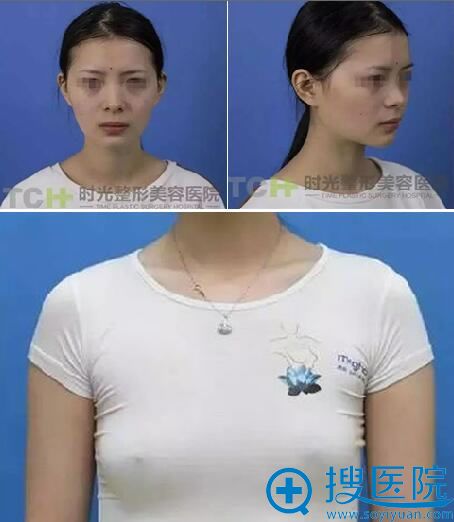 杭州时光假体丰胸+综合隆鼻及全面部脂肪填充 让她完成人生逆转