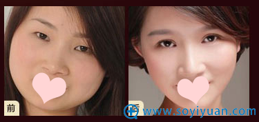 新疆华美整形医院李艳霞双眼皮真人案例 新疆华美整形医院李艳霞双眼皮真人案例