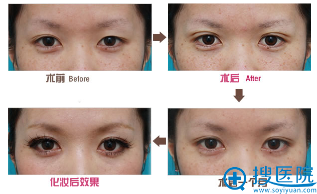 乌鲁木齐华美李艳霞双眼皮前后对比案例 乌鲁木齐华美李艳霞双眼皮前后对比案例