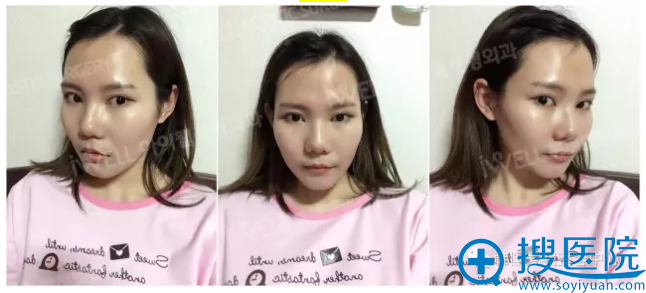 术前照片 术前照片