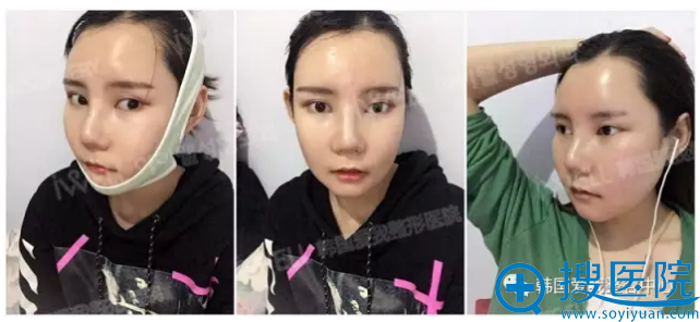 颧骨手术术后半个月效果 颧骨手术术后半个月效果
