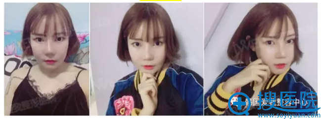 轮廓手术一个月啦 轮廓手术一个月啦