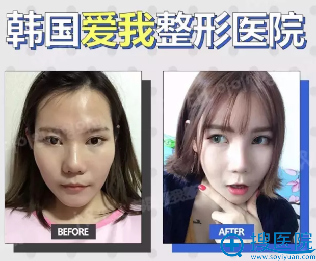 面部轮廓三件套术前术后对比照 面部轮廓三件套术前术后对比照