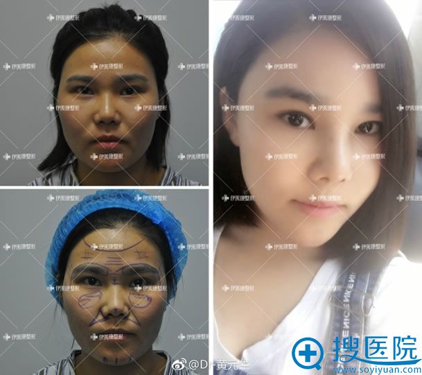 <!--<i data=20240710 data-id=11985></i>-->黄元生脂肪填充案例 <!--<i data=20240710 data-id=11985></i>-->黄元生脂肪填充案例