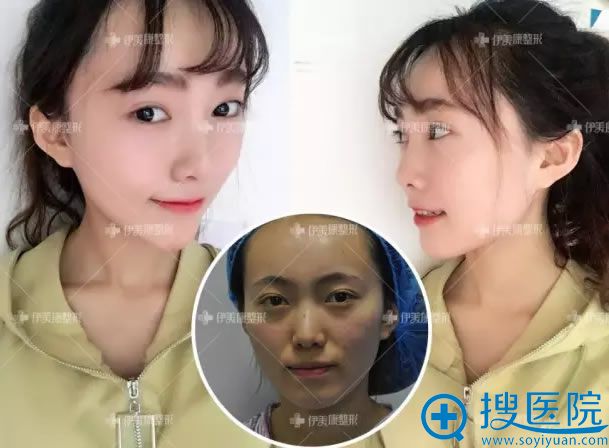 北京黄元生脂肪填充心形脸案例 北京黄元生脂肪填充心形脸案例