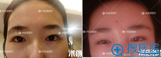 北京黄元生自体脂肪丰太阳穴案例 北京黄元生自体脂肪丰太阳穴案例