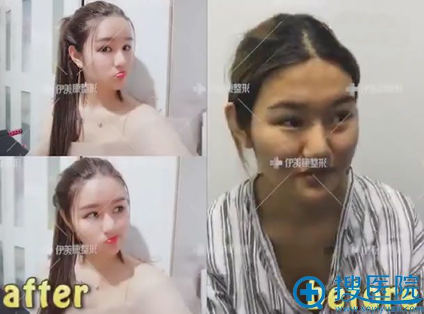 自体脂肪填充全脸一个月效果 自体脂肪填充全脸一个月效果