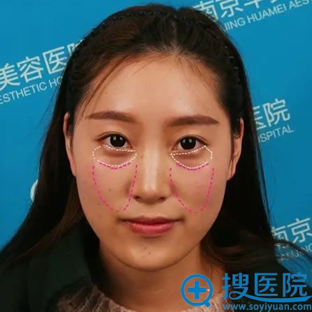 ���Ͼ�����������֬���沿�����ǰ��
