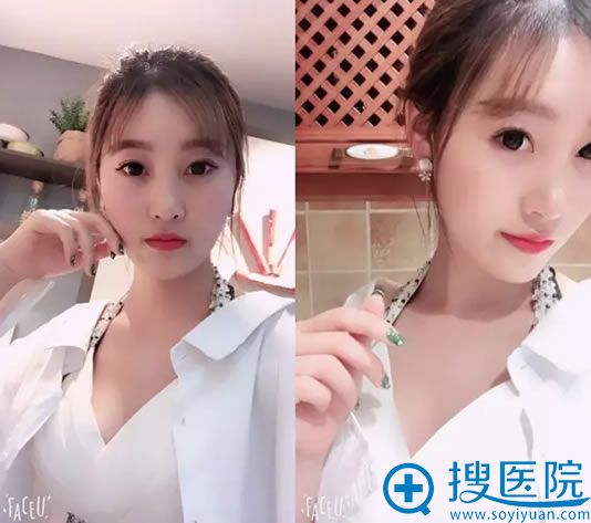 �����沿֬����������Ч��