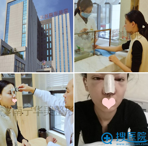 来南宁华美找胡凯做鼻综合面诊术后全过程 来南宁华美找胡凯做鼻综合面诊术后全过程