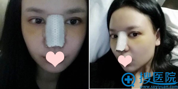 胡凯医生做鼻综合第六天的效果 胡凯医生做鼻综合第六天的效果