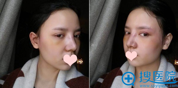 鼻综合术后第七天拆线后的样子 鼻综合术后第七天拆线后的样子