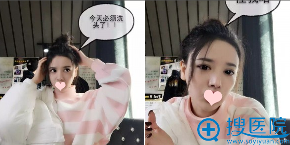 鼻综合术后21天恢复效果 鼻综合术后21天恢复效果
