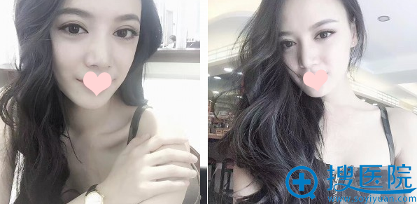 做了鼻综合后现在的我。 做了鼻综合后现在的我。