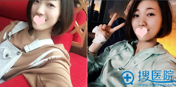 对比了重庆华美和铜雀台的价格后找何春涛做了全切双眼皮和隆鼻