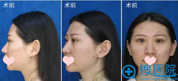 去年暑假找沈阳杏林张宇夫做了期待已久的隆鼻和隆下巴手术