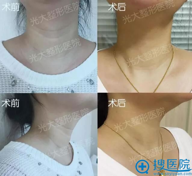 脖子颈纹很深怎么消除 永康光大嗨体水光温柔祛除颈部痕迹