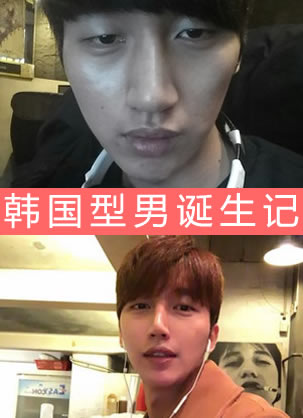 【型男诞生记】韩国芙莱思整形医院男生自体脂肪填充图