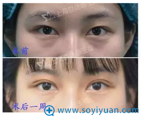 <!--<i data=20240710 data-id=14211></i>-->王维主任双眼皮案例 <!--<i data=20240710 data-id=14211></i>-->王维主任双眼皮案例