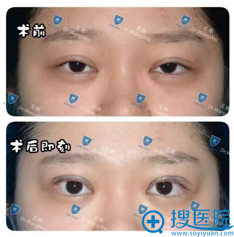 王维主任双眼皮过宽修复案例 王维主任双眼皮过宽修复案例