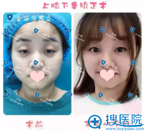 <!--<i data=20240710 data-id=14211></i>-->整形医院王维主任上睑下垂矫正案例 <!--<i data=20240710 data-id=14211></i>-->整形医院王维主任上睑下垂矫正案例