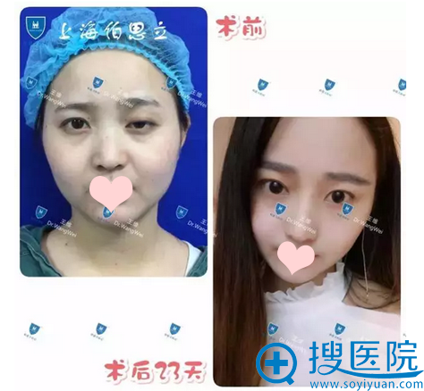 <!--<i data=20240710 data-id=14211></i>-->整形医院王维主任双眼皮修复案例 <!--<i data=20240710 data-id=14211></i>-->整形医院王维主任双眼皮修复案例