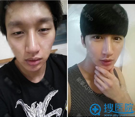 男生自体脂肪填充前后对比图 男生自体脂肪填充前后对比图