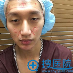 全脸自体填充手术设计方案 全脸自体填充手术设计方案