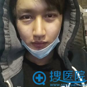 男生做完全脸填充手术当天照片 男生做完全脸填充手术当天照片